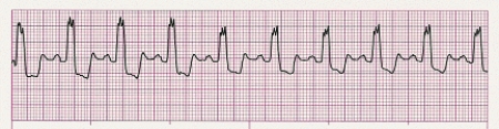 Identify the following rhythm (lead II): ____________________   