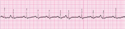 Identify the following rhythm (lead II) .   A)  Atrial fibrillation B)  Sinus arrhythmia C)  Multifocal atrial tachycardia D)  Sinus tachycardia with premature atrial complexes (PACs) 