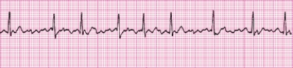 P waves in this rhythm strip _____.   A)  are upright before every QRS complex B)  are inverted before every QRS complex C)  vary in size and shape D)  are not identifiable