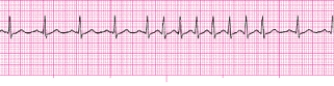 Identify the following rhythm (lead II) .   A)  Sinus arrhythmia B)  Atrial tachycardia C)  Multifocal atrial tachycardia with a PAC D)  Sinus rhythm with a PAC,a run of PSVT,back to a sinus rhythm