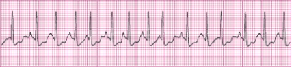 P waves in this rhythm strip _____.   A)  are upright before every QRS complex B)  are inverted before every QRS complex C)  vary in size and shape D)  are not identifiable