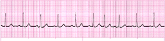 Identify the following rhythm (lead II) .   A)  Sinus arrhythmia B)  Sinus tachycardia C)  Sinus rhythm with a PAC D)  Sinus tachycardia with a PAC