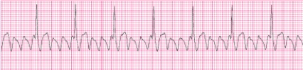 Identify the following rhythm (lead II) .   A)  Atrial flutter B)  Atrial fibrillation C)  Wolff-Parkinson-White syndrome D)  AV nodal reentrant tachycardia (AVNRT) 