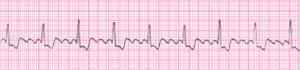 P waves in this rhythm strip _____.   A)  occur regularly B)  are not identifiable; fibrillatory waves are present C)  are upright before every QRS complex D)  are not identifiable; flutter waves are present