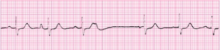 Identify the following rhythm (lead II): ____________________   
