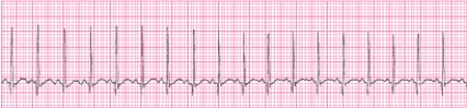 Identify the following rhythm (lead II): ____________________   