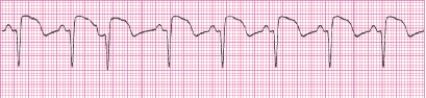 Identify the following rhythm (lead II): ____________________   