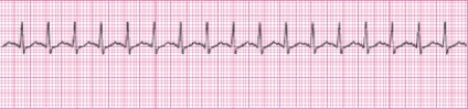 Identify the following rhythm (lead II): ____________________   