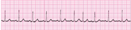 Identify the following rhythm (lead II): ____________________   
