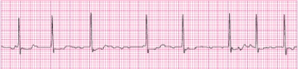 Identify the following rhythm (lead II): ____________________   