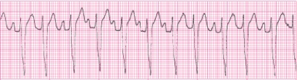 Identify the following rhythm (lead II): ____________________   