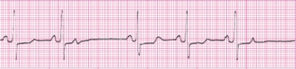 Identify the following rhythm (lead II): ____________________   
