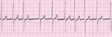 Identify the following rhythm (lead II): ____________________   