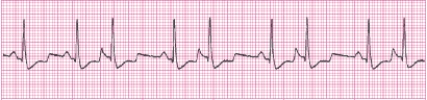 Identify the following rhythm (lead II): ____________________   