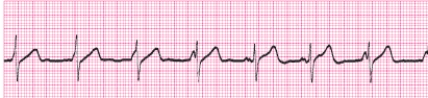Identify the following rhythm (lead II): ____________________   