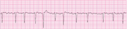 Identify the following rhythm (lead MCL?): ____________________   