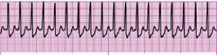 Identify the following rhythm (lead II): ____________________   