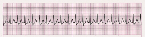 Identify the following rhythm (lead II): ____________________   