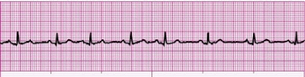 Identify the following rhythm (lead II): ____________________   