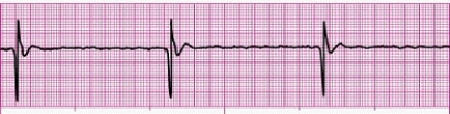 Identify the following rhythm (lead II): ____________________   