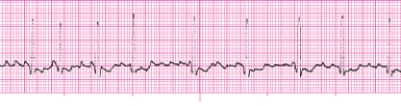 Identify the following rhythm (lead II): ____________________   