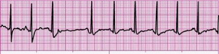 Identify the following rhythm (lead II): ____________________   