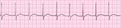 Identify the following rhythm (lead II) .   A)  Accelerated junctional rhythm B)  Sinus rhythm C)  Junctional rhythm D)  Sinus arrhythmia