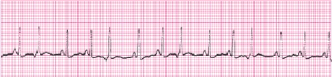 Identify the following rhythm (lead II) .   A)  Sinus arrhythmia B)  Sinus rhythm with junctional escape beats C)  Sinus tachycardia with premature atrial complexes D)  Sinus tachycardia with premature junctional complexes