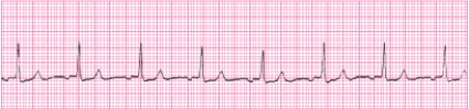 Identify the following rhythm (lead II) .   A)  Junctional tachycardia B)  Sinus rhythm with PACs C)  Sinus rhythm with PJCs D)  Accelerated junctional rhythm
