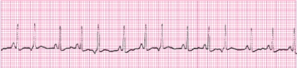 Identify the following rhythm (lead II): ____________________   