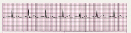 Identify the following rhythm (lead II): ____________________   
