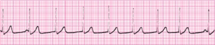 Identify the following rhythm (lead II): ____________________   