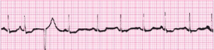 Identify the following rhythm (lead II): ____________________   