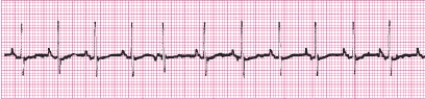 Identify the following rhythm (lead II): ____________________   