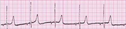 Identify the following rhythm (lead II): ____________________   