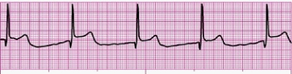 Identify the following rhythm (lead II): ____________________   