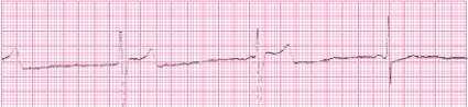Identify the following rhythm (lead II): ____________________   