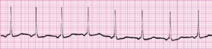 Identify the following rhythm (lead II): ____________________   
