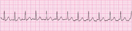 Identify the following rhythm (lead II): ____________________   