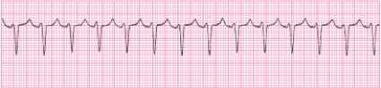 Identify the following rhythm (lead II): ____________________   