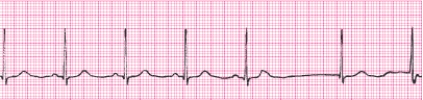 Identify the following rhythm (lead II): ____________________   