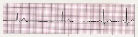 Identify the following rhythm (lead II): ____________________   
