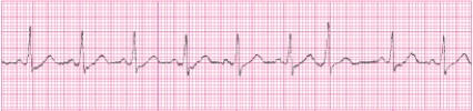 Identify the following rhythm (lead II): ____________________   