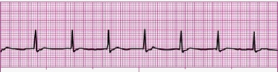 Identify the following rhythm (lead II): ____________________   