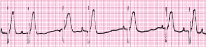 Identify the following rhythm (lead II): ____________________   