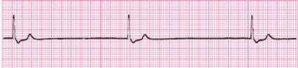 Identify the following rhythm (lead II): ____________________   