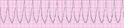 Identify the following rhythm (lead II): ____________________   