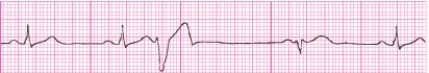 Identify the following rhythm (lead II): ____________________   