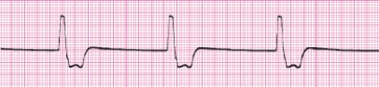 Identify the following rhythm (lead II): ____________________   