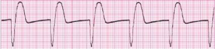 Identify the following rhythm (lead II): ____________________   